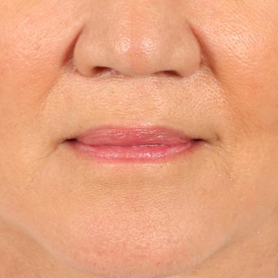 Lip Lift Before & After Gallery - Patient 369254 - Image 2