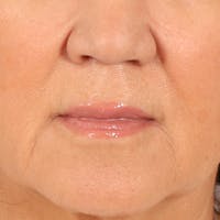 Lip Lift Before & After Gallery - Patient 369254 - Image 1