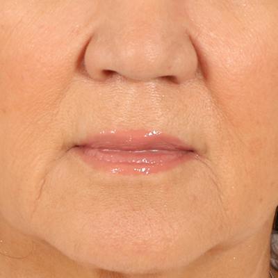 Lip Lift Before & After Gallery - Patient 369254 - Image 1