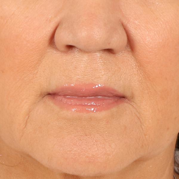 Lip Lift Before & After Gallery - Patient 369254 - Image 1