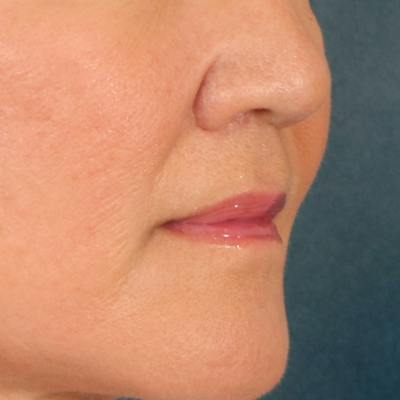 Lip Lift Before & After Gallery - Patient 369254 - Image 4