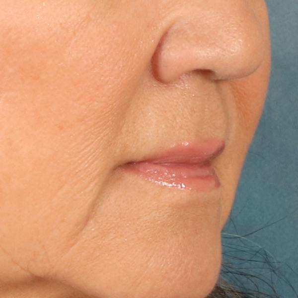 Lip Lift Before & After Gallery - Patient 369254 - Image 3