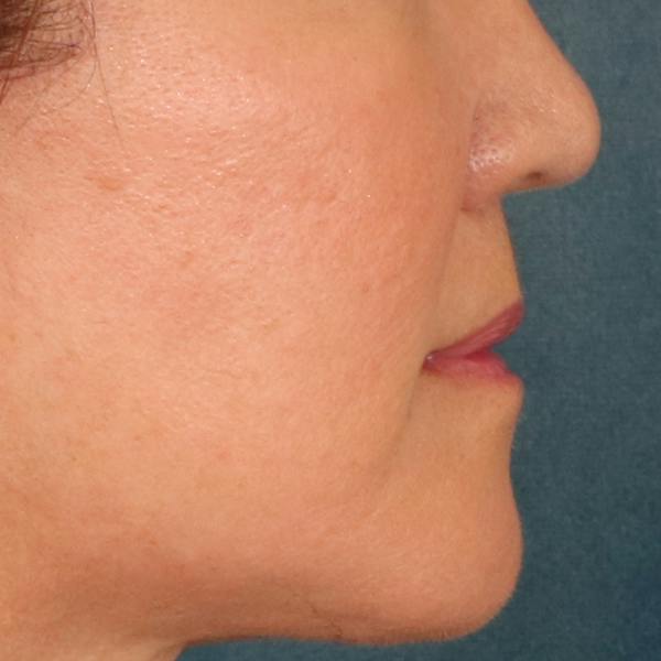 Lip Lift Before & After Gallery - Patient 369254 - Image 6