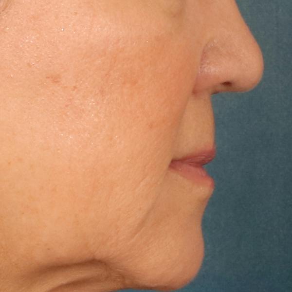 Lip Lift Before & After Gallery - Patient 369254 - Image 5