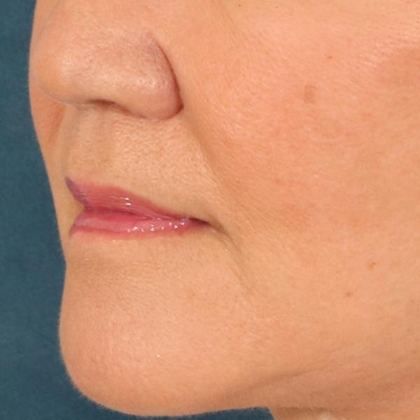 Lip Lift Before & After Gallery - Patient 369254 - Image 8