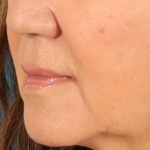 Lip Lift Before & After Gallery - Patient 369254 - Image 7
