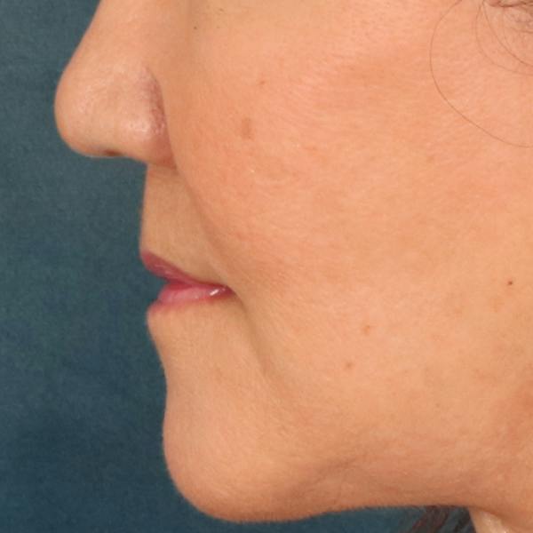 Lip Lift Before & After Gallery - Patient 369254 - Image 10