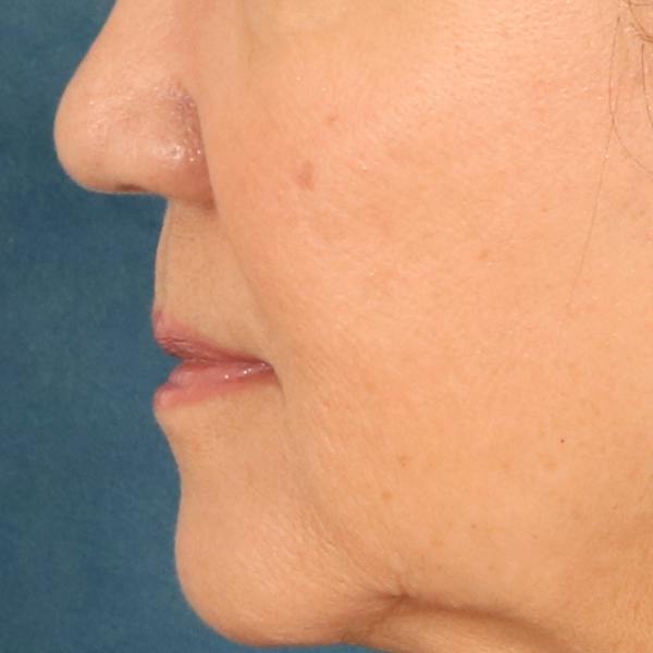 Lip Lift Before & After Gallery - Patient 369254 - Image 9