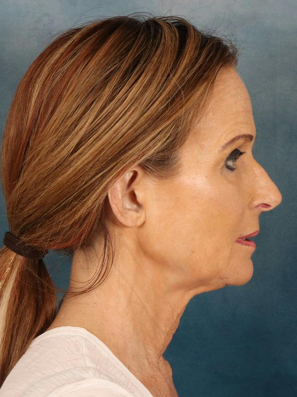 Deep Plane Facelift Before & After Gallery - Patient 422724 - Image 9