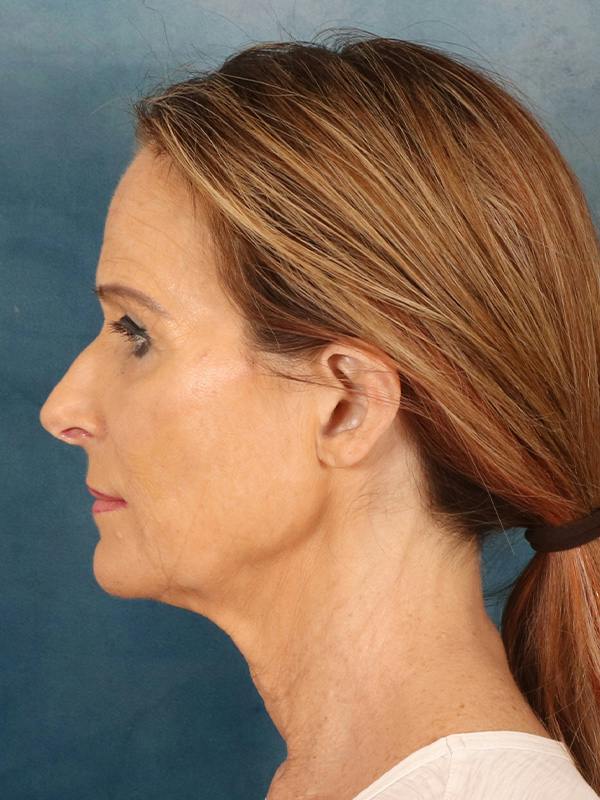 Deep Plane Facelift Before & After Gallery - Patient 422724 - Image 3