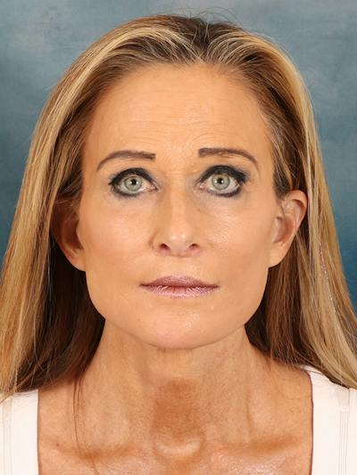 Deep Plane Facelift Before & After Gallery - Patient 422724 - Image 6