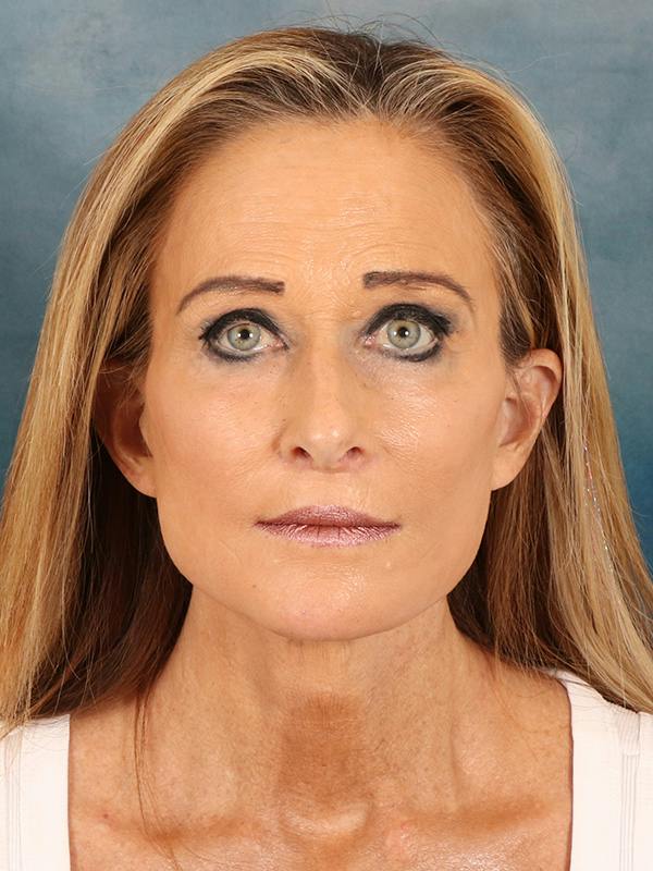 Deep Plane Facelift Before & After Gallery - Patient 422724 - Image 6