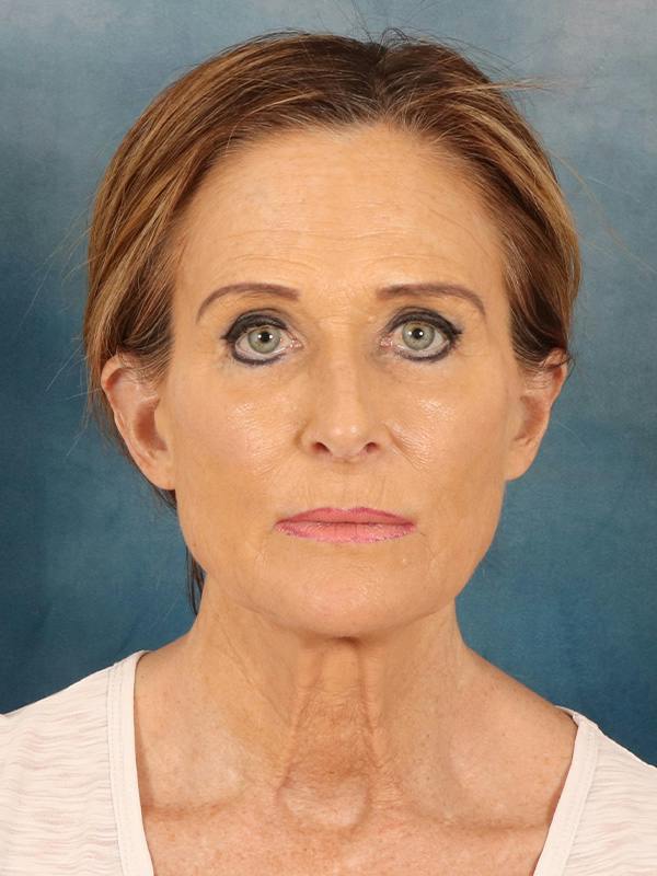 Deep Plane Facelift Before & After Gallery - Patient 422724 - Image 5