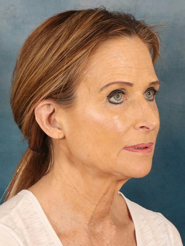 Deep Plane Facelift Before & After Gallery - Patient 422724 - Image 7