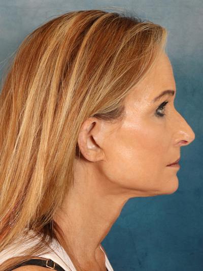 Deep Plane Facelift Before & After Gallery - Patient 422724 - Image 10