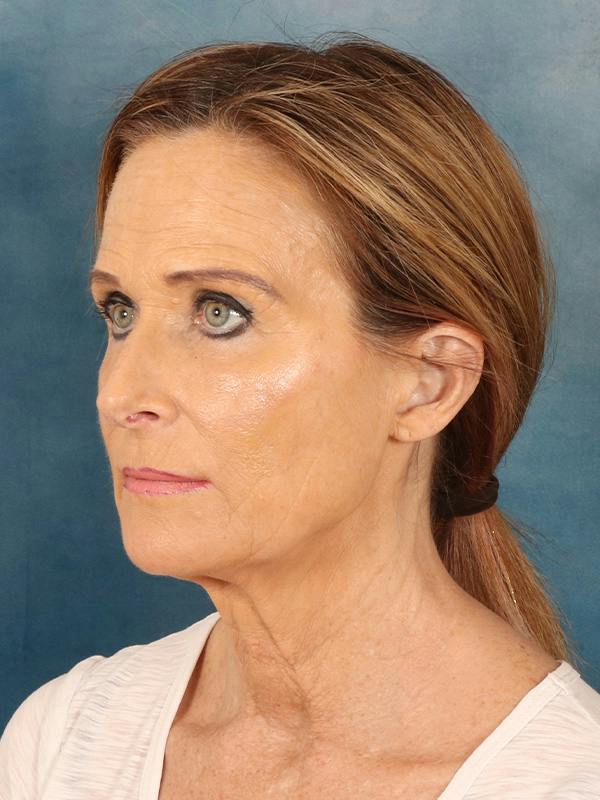 Deep Plane Facelift Before & After Gallery - Patient 422724 - Image 1