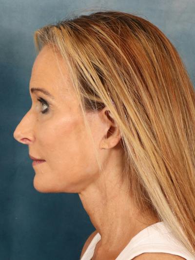 Deep Plane Facelift Before & After Gallery - Patient 422724 - Image 4