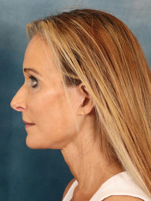 Deep Plane Facelift Before & After Gallery - Patient 422724 - Image 4
