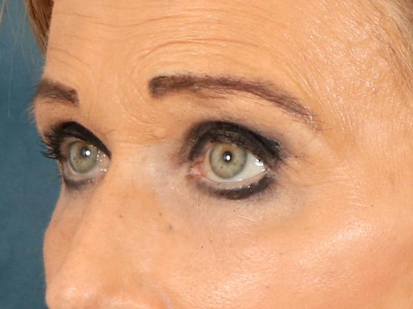 Eyelid Lift Before & After Gallery - Patient 376775 - Image 8