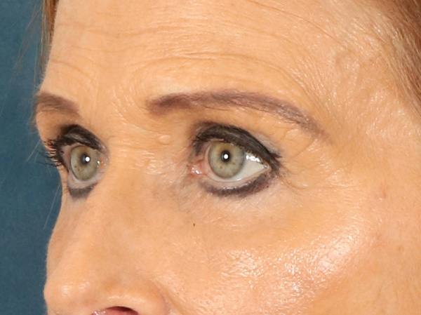 Eyelid Lift Before & After Gallery - Patient 376775 - Image 7