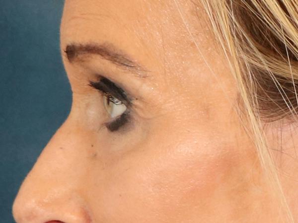 Eyelid Lift Before & After Gallery - Patient 376775 - Image 10