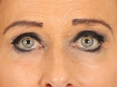 Eyelid Lift Before & After Gallery - Patient 376775 - Image 2