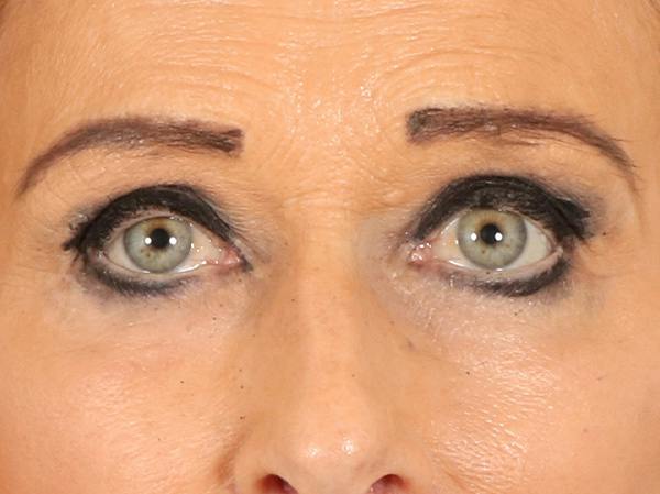Eyelid Lift Before & After Gallery - Patient 376775 - Image 2