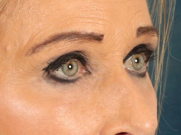 Eyelid Lift Before & After Gallery - Patient 376775 - Image 4