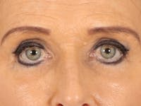 Eyelid Lift Before & After Gallery - Patient 376775 - Image 1