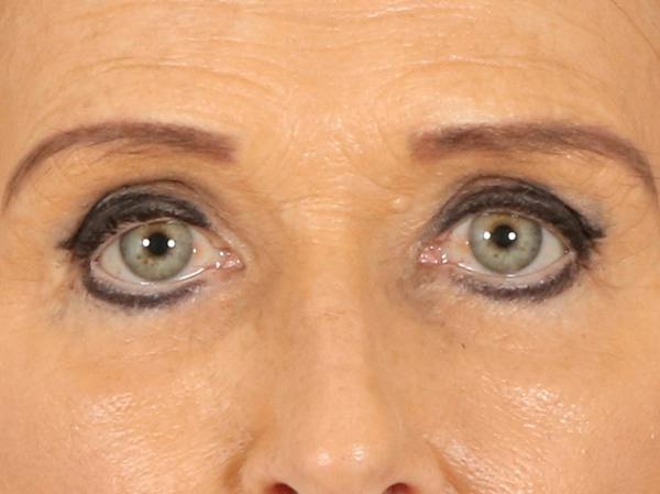 Eyelid Lift Before & After Gallery - Patient 376775 - Image 1