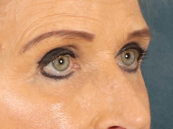 Eyelid Lift Before & After Gallery - Patient 376775 - Image 3