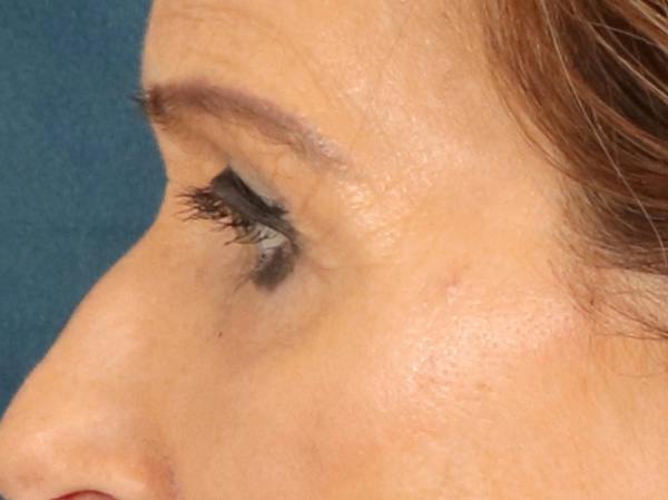 Eyelid Lift Before & After Gallery - Patient 376775 - Image 9