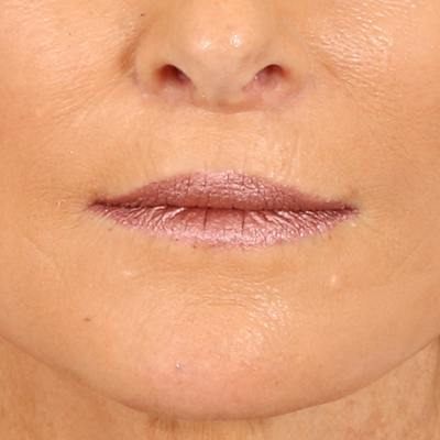 Lip Lift Before & After Gallery - Patient 112397 - Image 2