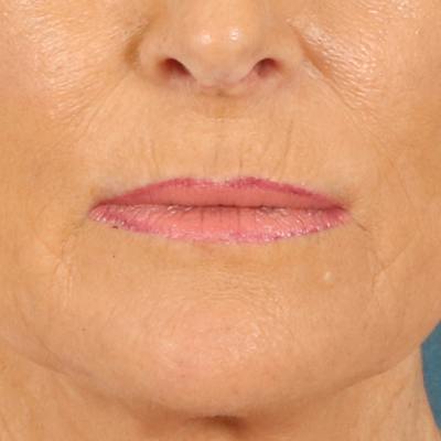 Lip Lift Before & After Gallery - Patient 112397 - Image 1