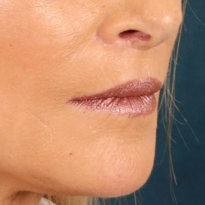 Lip Lift Before & After Gallery - Patient 112397 - Image 4