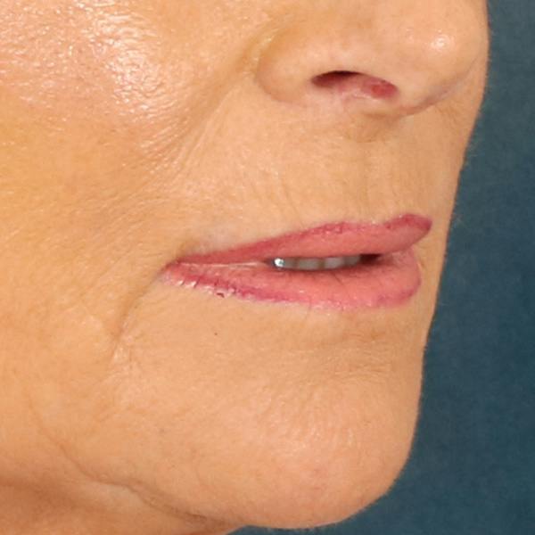 Lip Lift Before & After Gallery - Patient 112397 - Image 3