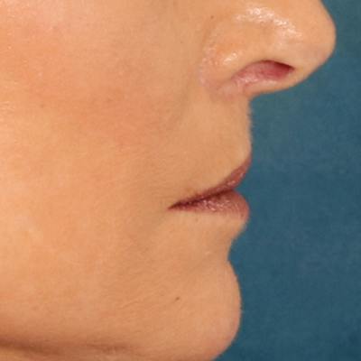 Lip Lift Before & After Gallery - Patient 112397 - Image 6