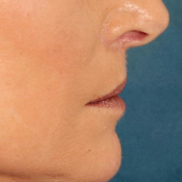 Lip Lift Before & After Gallery - Patient 112397 - Image 6