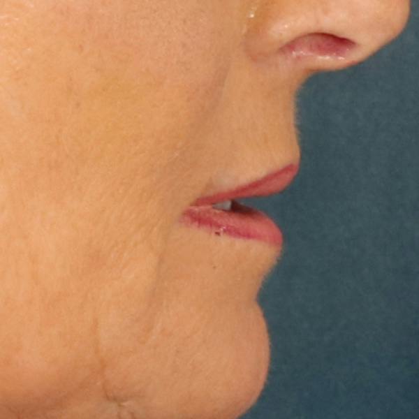 Lip Lift Before & After Gallery - Patient 112397 - Image 5