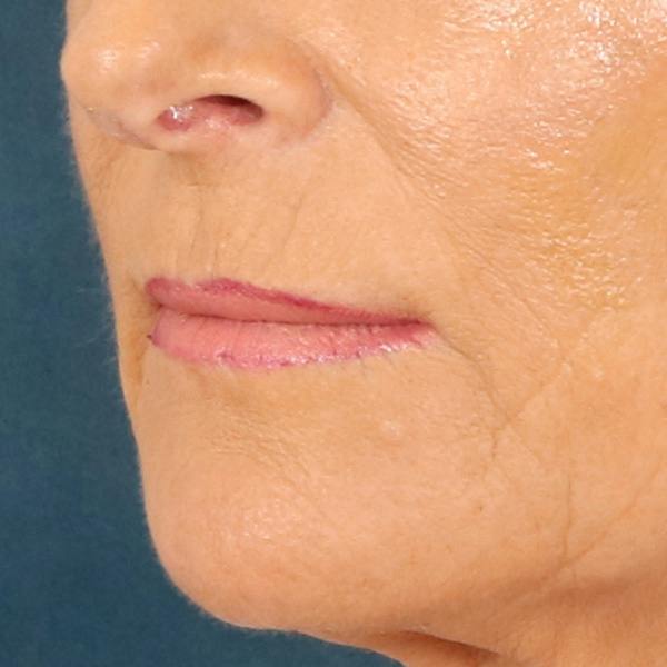 Lip Lift Before & After Gallery - Patient 112397 - Image 7