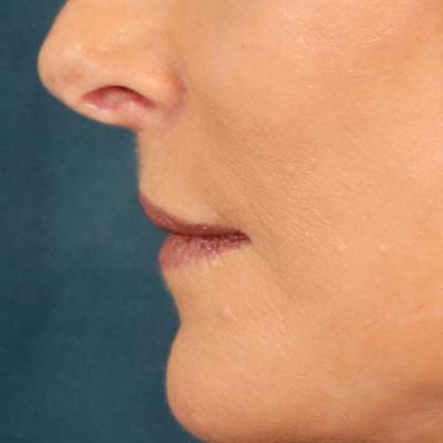 Lip Lift Before & After Gallery - Patient 112397 - Image 10