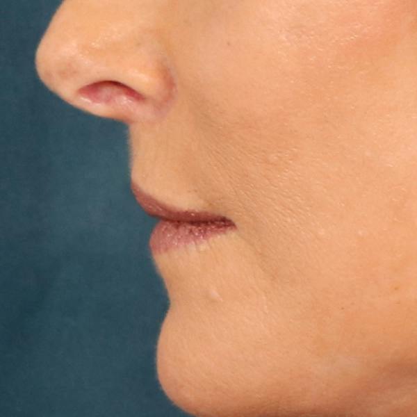 Lip Lift Before & After Gallery - Patient 112397 - Image 10