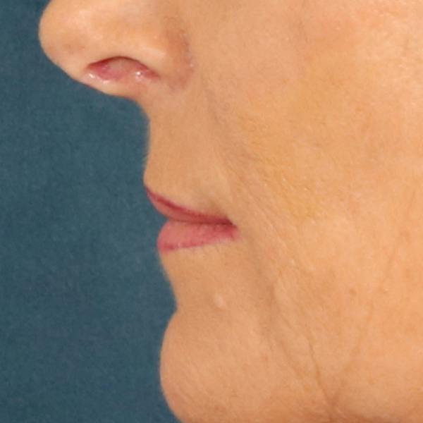 Lip Lift Before & After Gallery - Patient 112397 - Image 9