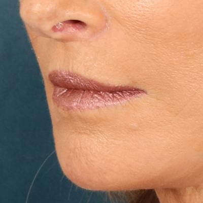 Lip Lift Before & After Gallery - Patient 112397 - Image 8