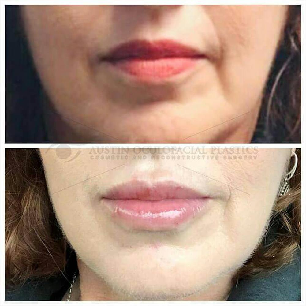Dermal Fillers