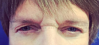 Blepharoplasty Before Image