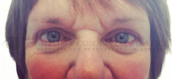 Blepharoplasty After Image