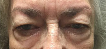 Blepharoplasty Before Image