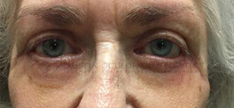 Blepharoplasty After Image