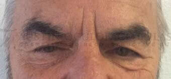 Blepharoplasty Before Image